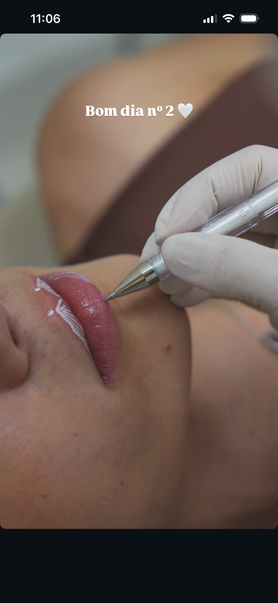 Procedimento de preenchimento facial